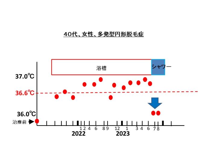 円形脱毛症　病院